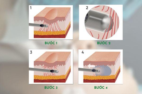 Thông tin cơ bản cần nắm về thủ thuật tách đáy sẹo