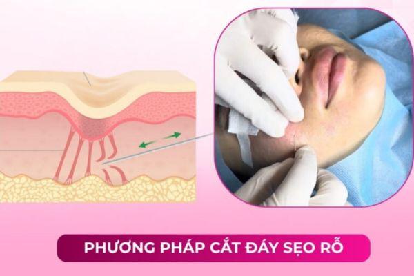 Cắt đáy sẹo phù hợp hoặc không phù hợp cho đối tượng nào?