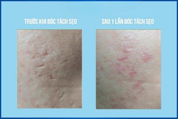 Ưu điểm và nhược điểm của cắt chân sẹo là gì?