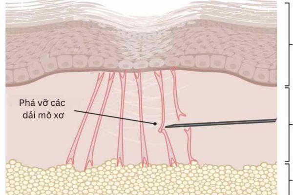 7 bước cắt chân sẹo cần nắm trước khi điều trị thực tế