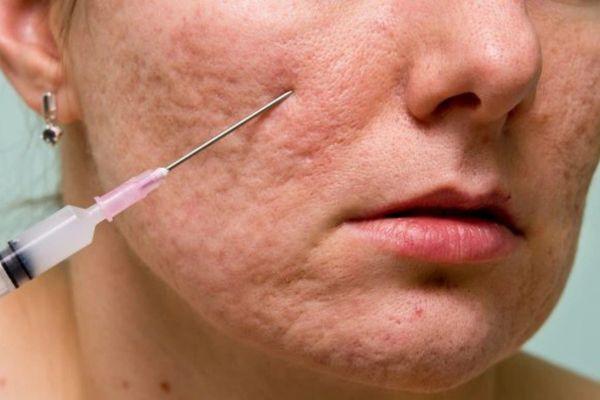 Chăm sóc sau điều trị cắt đáy sẹo thế nào để nhanh lành?