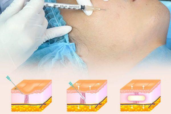 Bóc Tách Đáy Sẹo - Giải Pháp Phục Hồi Bề Mặt Da Hiệu Quả