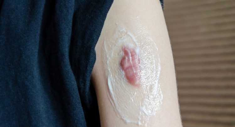 Bôi kem dưỡng ẩm giúp làm mềm sẹo và giảm tăng sinh collagen