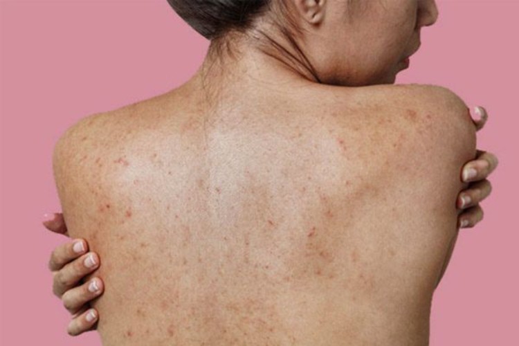 Bôi thuốc gì để giải quyết mụn lưng?