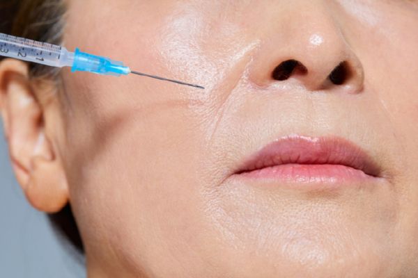 Tiêm botox xóa nhăn an toàn khi thực hiện đúng kỹ thuật và liều lượng