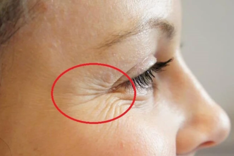 Botox xóa nhăn đuôi mắt phù hợp với người có nếp nhăn động quanh mắt