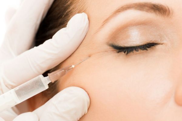 Botox xóa nhăn đuôi mắt