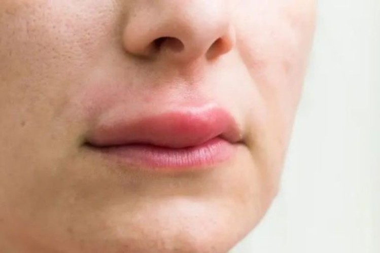 Một số phản ứng nhẹ sau tiêm filler hoặc botox là hiện tượng bình thường