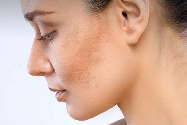 Ăn gì và kiêng gì khi trị nám mặt bằng công nghệ laser?