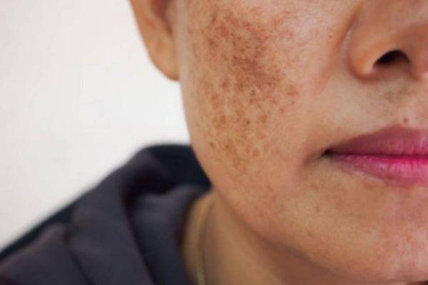 Sai lầm nào khiến cho nám tái phát sau laser?
