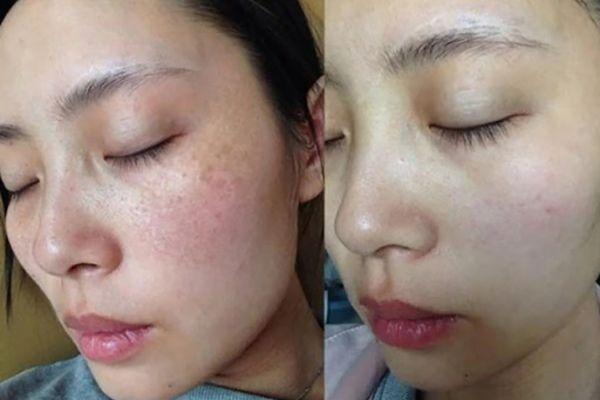 FAQs về cách chăm sóc da sau sau khi trị nám bằng laser