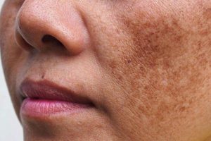 Cách Chăm Sóc Da Sau Khi Bắn Laser Trị Nám Giảm Kích Ứng