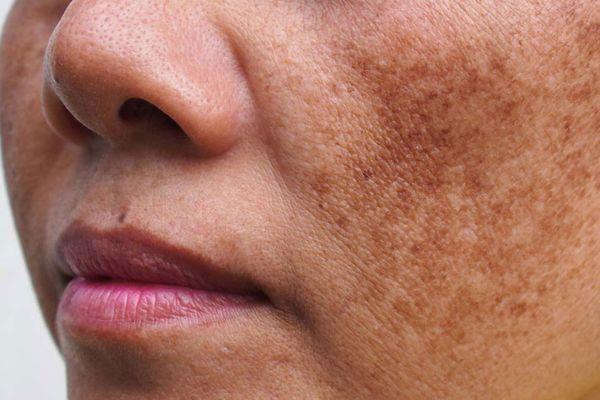 Cách Chăm Sóc Da Sau Khi Bắn Laser Trị Nám Giảm Kích Ứng