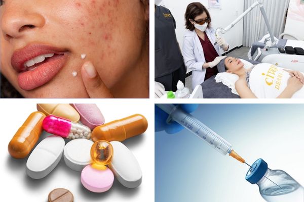Các liệu pháp có thể điều trị mụn bọc