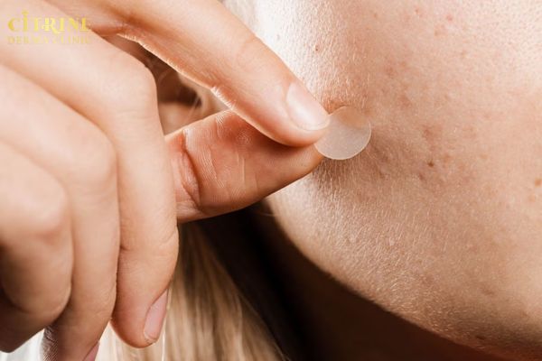 Dùng miếng dán mụn giúp bảo vệ và giảm sưng sau khi nặn