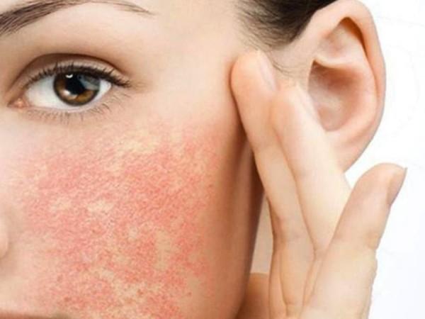 Tình trạng da mặt bị ửng đỏ sau khi tái tạo