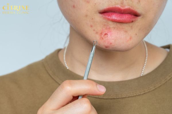 Phân biệt các loại mụn ở cằm dựa vào kích thước màu sắc và cảm giác