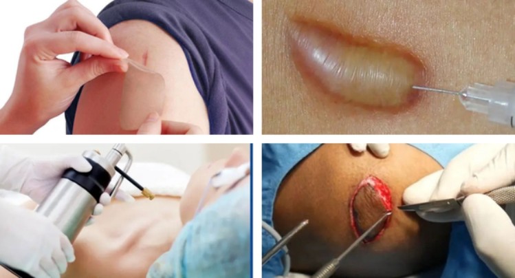 cách trị sẹo lồi co kéo