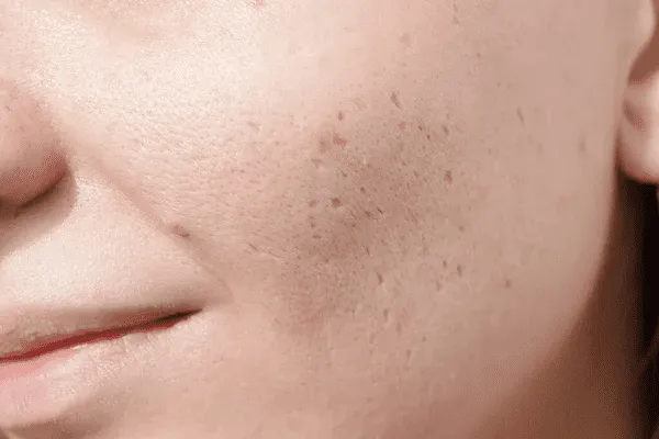Hình ảnh sẹo lõm ở mặt