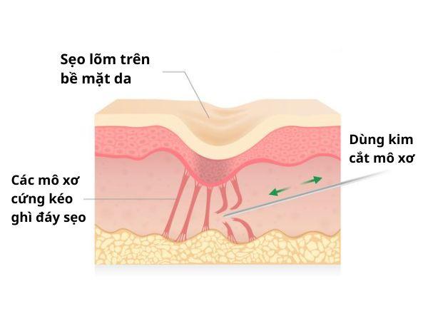 Quá trình bóc tách đáy sẹo lõm