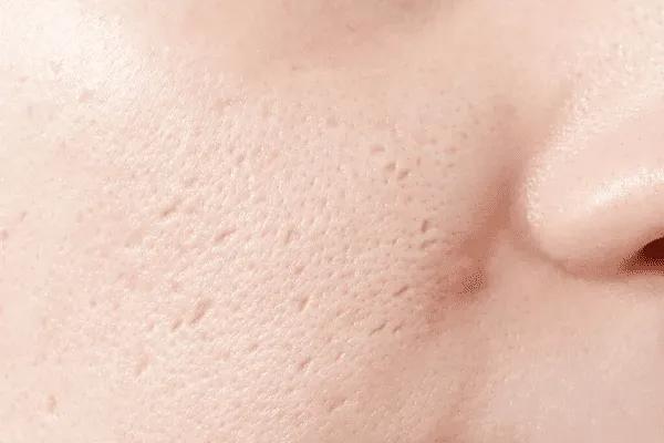 Sẹo Lõm Lâu Năm Trị Được Không? Cách Phòng Ngừa Và Điều Trị