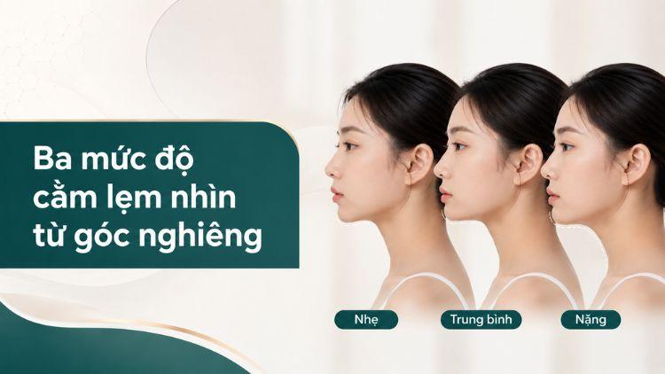 Ba mức độ cằm lẹm nhìn từ góc nghiêng