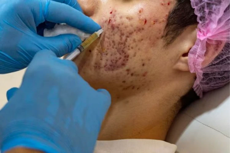 Cận cảnh quá trình tiêm meso trị mụn