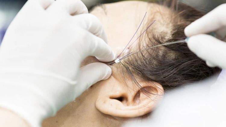 Căng chỉ thẩm mỹ phù hợp khi cần nâng đỡ mô rõ hơn