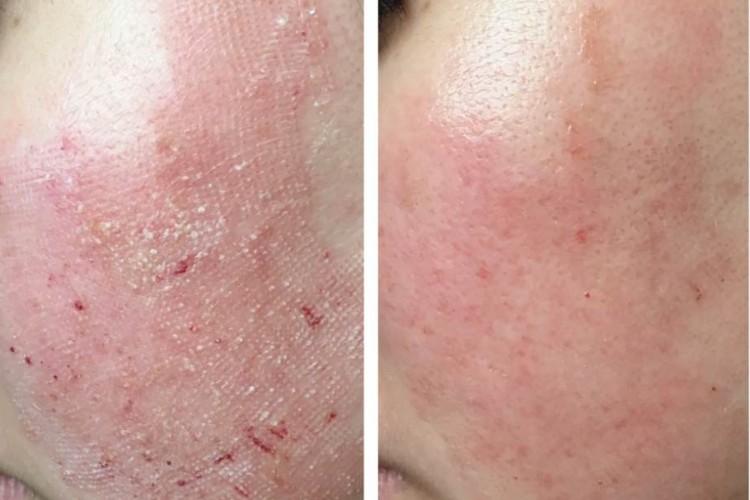 Làn da sau khi được điều trị bằng Laser CO2 trong 24 giờ đầu