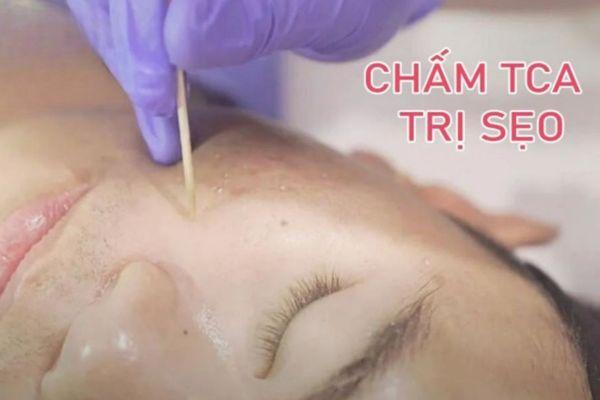 Khái quát sơ lược về thủ thuật chấm sẹo TCA