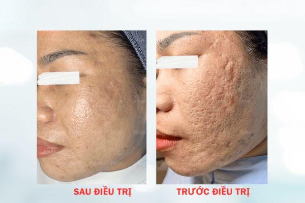 Giá chấm sẹo TCA bạn nên nắm được trước khi quyết định điều trị