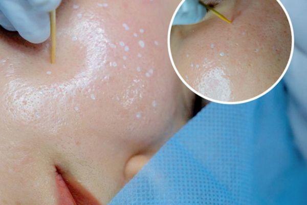 Điều bạn nên lưu ý khi muốn trị sẹo bằng TCA?