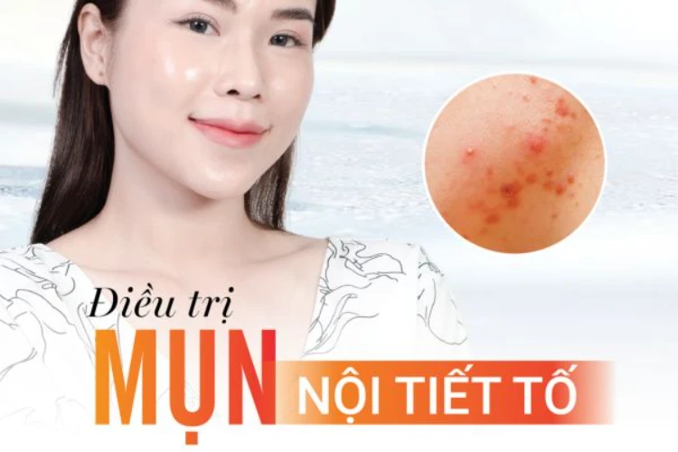 Chỉ cách xử lý mụn nội tiết hiệu quả và an toàn
