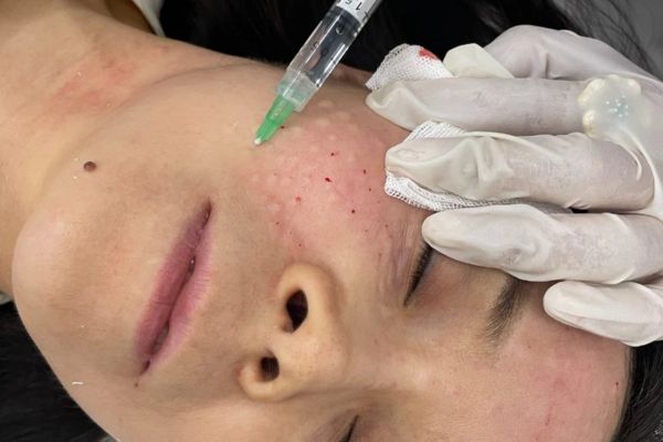 Citrine Derma Clinic thực hiện meso mụn chuẩn y khoa, cá nhân hóa an toàn