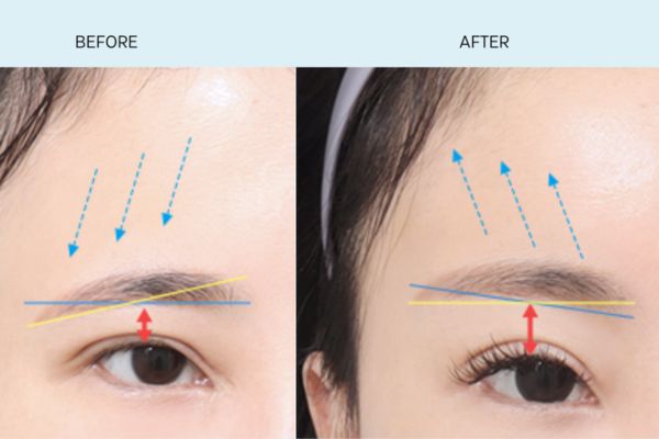 Citrine Derma Clinic là lựa chọn hoàn hảo nếu muốn treo khung mày