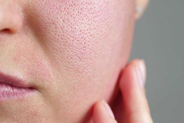 Lỗ chân lông giãn và biến dạng khiến bề mặt da rỗ nhẹ như vỏ cam