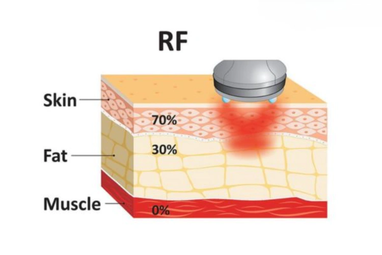 Sóng RF tạo nhiệt kích thích collagen, giúp da săn chắc và trẻ hoá