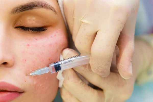 Meso trị mụn đưa hoạt chất vào trung bì, kiểm soát viêm và dầu