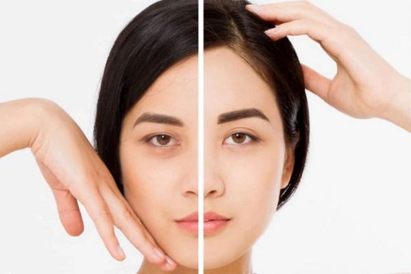 Có hai liệu pháp nâng cung lông mày đang được ưa chuộng