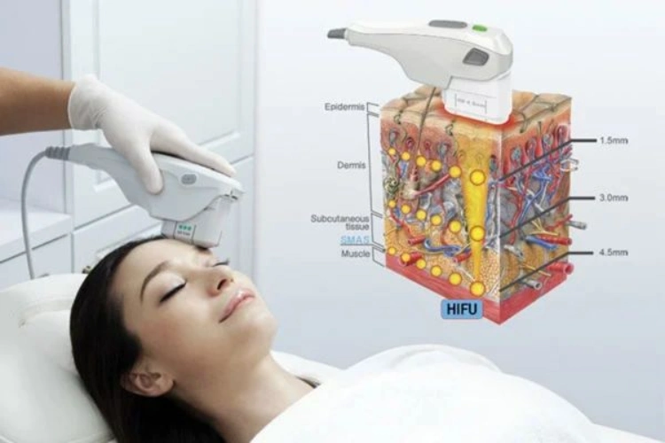 Công nghệ HIFU nâng cơ hoạt động bằng cách hội tụ sóng siêu âm vào lớp da sâu