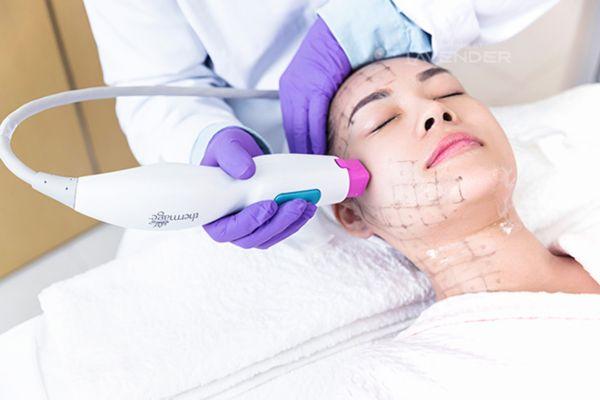Thermage FLX giúp săn chắc da, giảm nhăn bằng sóng RF
