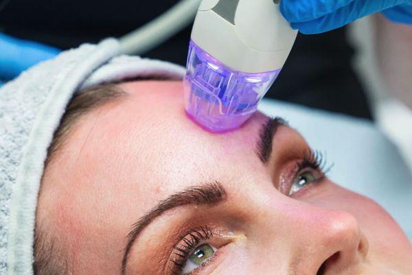 RF Microneedling cải thiện sẹo rỗ, se khít và tái tạo da sâu