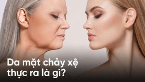 Da chùng vùng má và hàm do mô nâng đỡ suy yếu