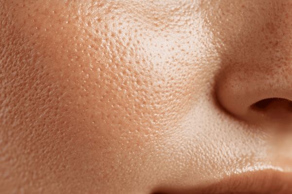 Da sần vỏ cam là dấu hiệu da suy yếu cấu trúc, kém mịn và mất độ đàn hồi tự nhiên