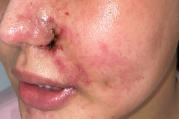 Đi khám ngay nếu có dấu hiệu bất thường sau tiêm filler