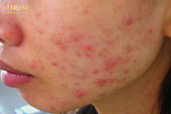 Nhận biết dấu hiệu viêm bất thường để xử lý kịp thời
