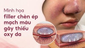 Minh họa filler chèn ép mạch máu gây thiếu oxy da