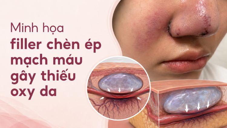 Minh họa filler chèn ép mạch máu gây thiếu oxy da