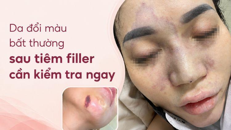 Da đổi màu bất thường sau tiêm filler cần kiểm tra ngay