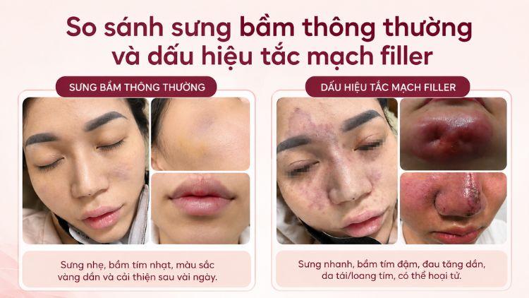 So sánh sưng bầm thông thường và dấu hiệu tắc mạch filler